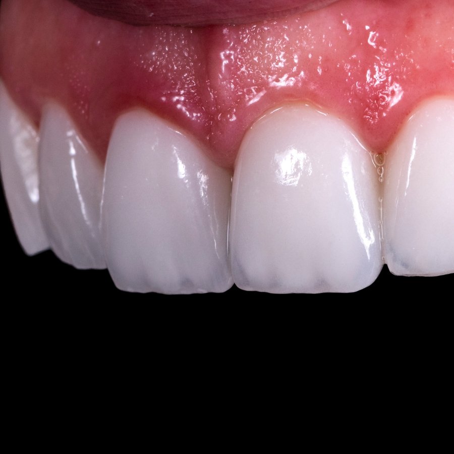 Porcelain veneers Pomona