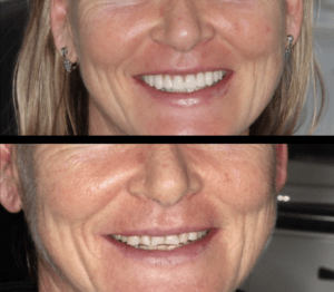 Before-and-after dental crown results demonstrating quality restorative care at Noosa Hinterland Dental.