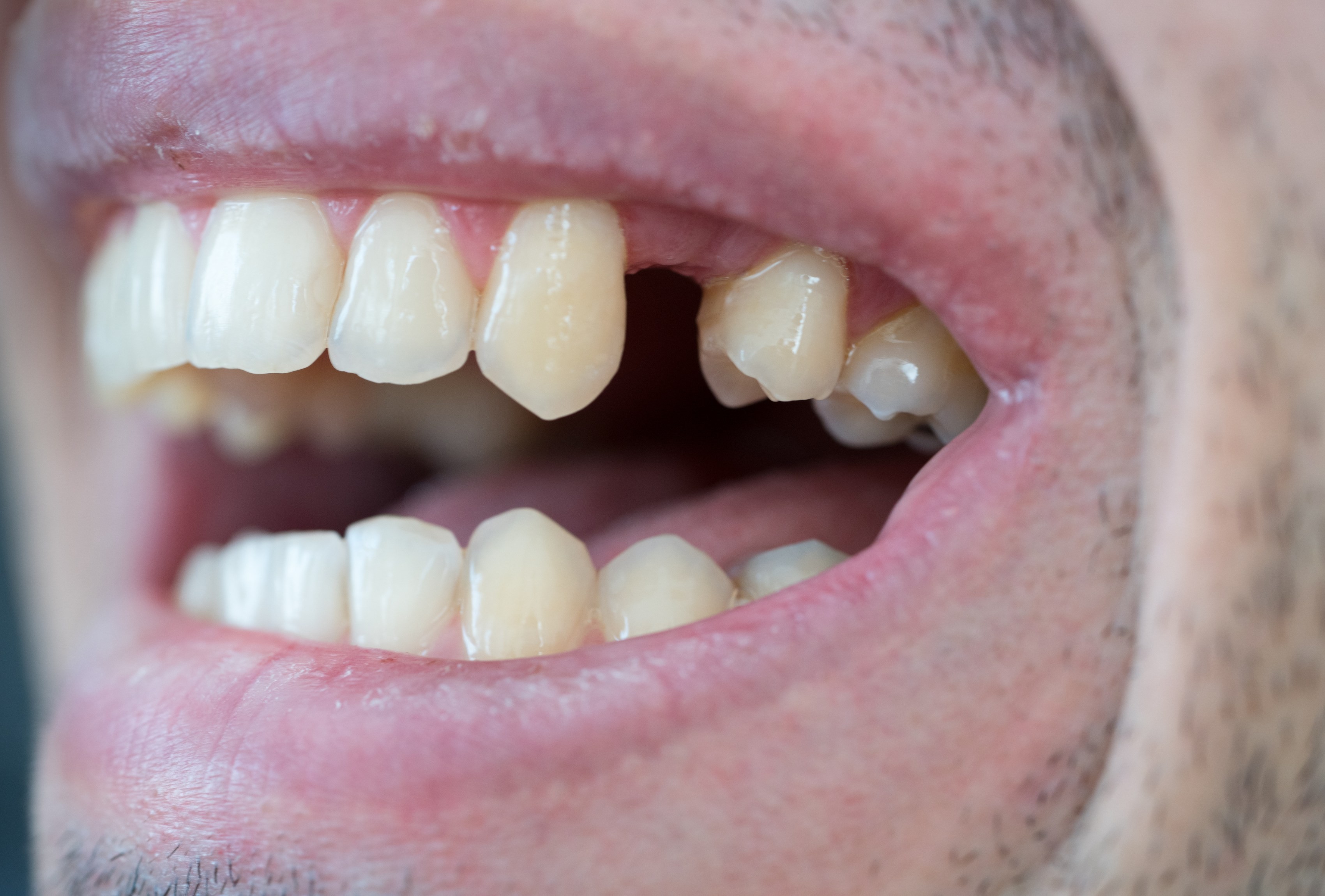 Close-up of a mouth with missing teeth, illustrating our dental implant and restorative treatments.