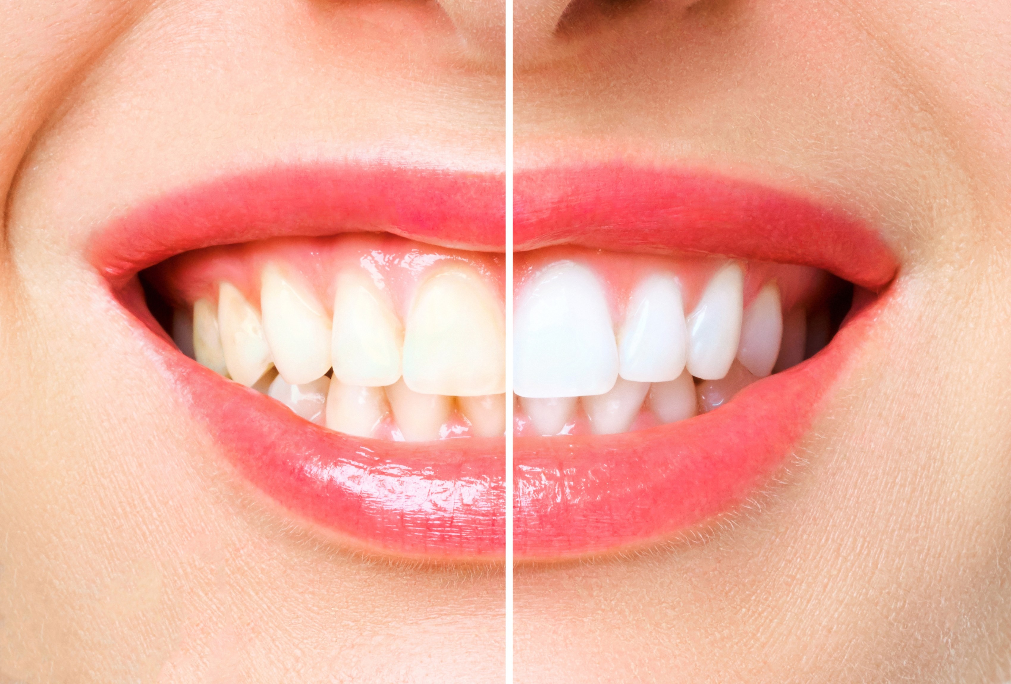 Before-and-after comparison of teeth showing whitening results at our Pomona clinic.