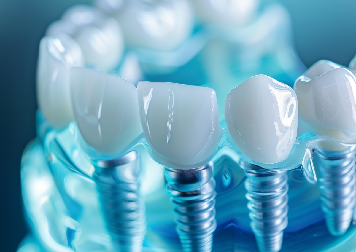 Dental implants supporting replacement teeth in the Noosa Hinterland