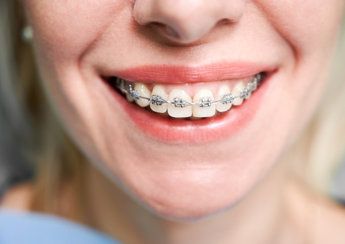 Adult patient smiling with traditional braces during orthodontic treatment on the Sunshine Coast