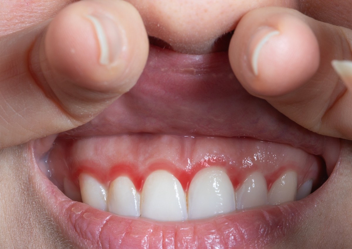 Early gum disease symptoms showing red and inflamed gums