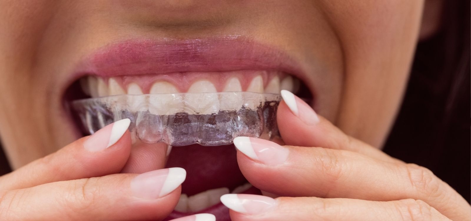 Invisalign treatment at Noosa Hinterland Dental in Pomona